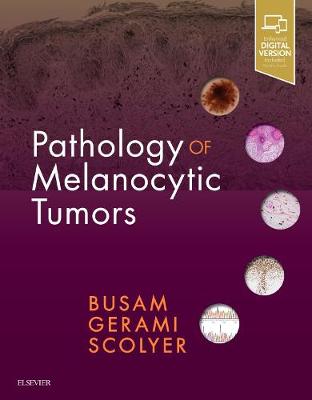 Pathology of Melanocytic Tumors | Zookal Textbooks | Zookal Textbooks