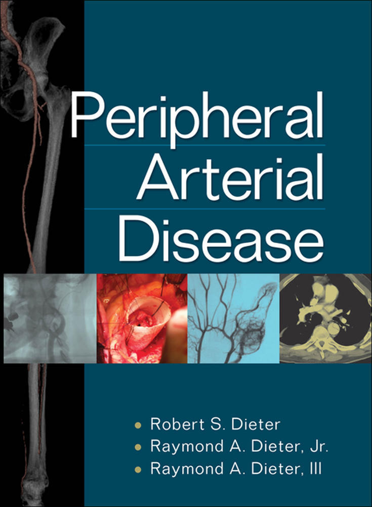 Peripheral Arterial Disease | Zookal Textbooks | Zookal Textbooks