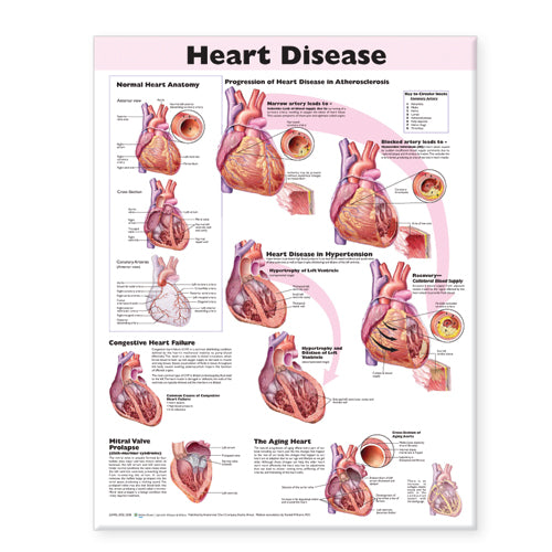 Heart Disease Anatomical Chart Laminated | Zookal Textbooks | Zookal Textbooks