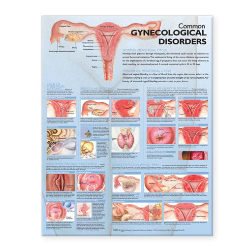 Common Gynecological Disorders Anatomical Chart Paper Unmounted | Zookal Textbooks | Zookal Textbooks