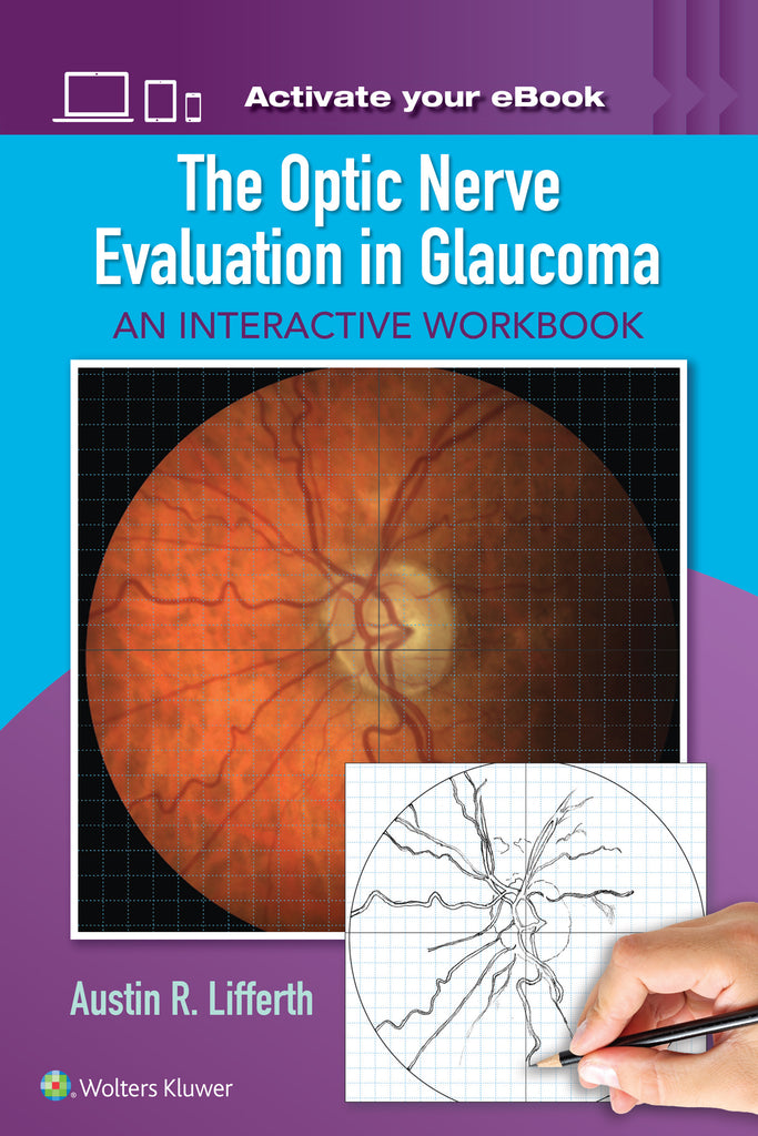 The Optic Nerve Evaluation in Glaucoma | Zookal Textbooks | Zookal Textbooks